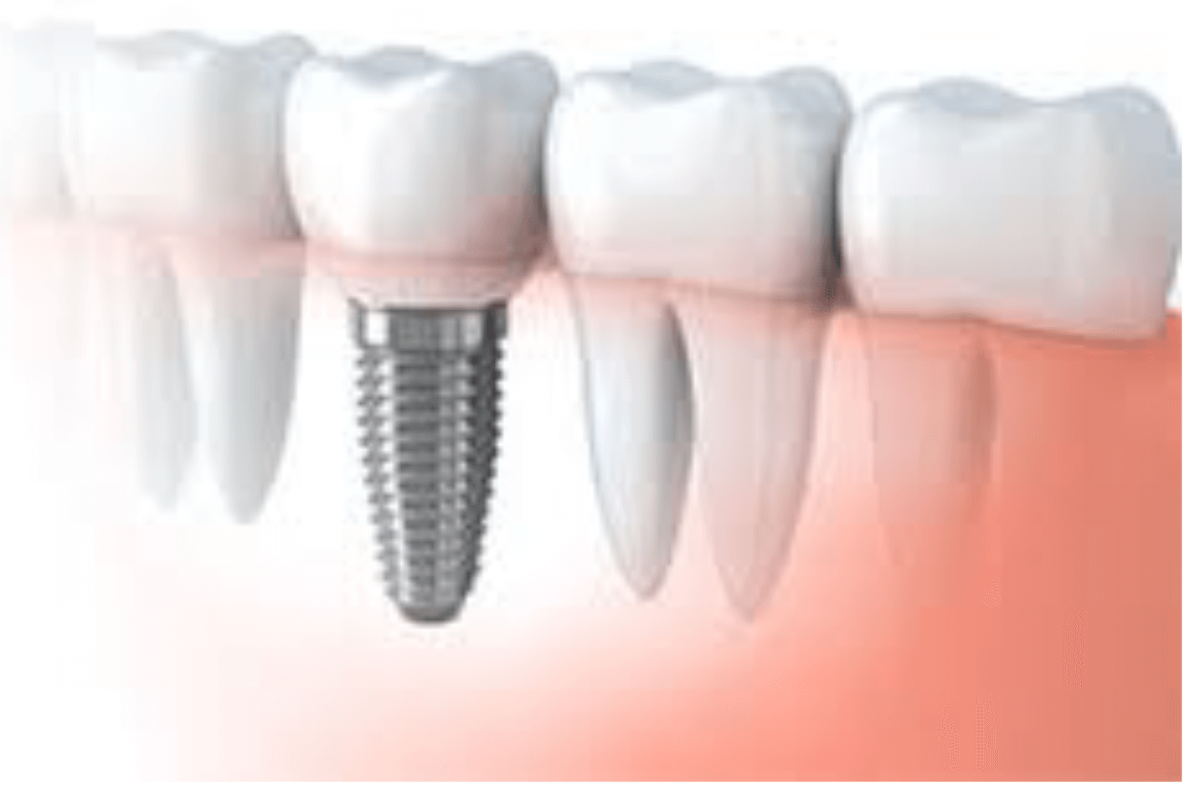 Зъбни импланти