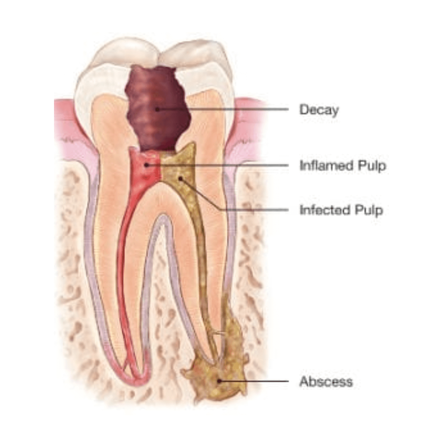 Коренные зубы нервы